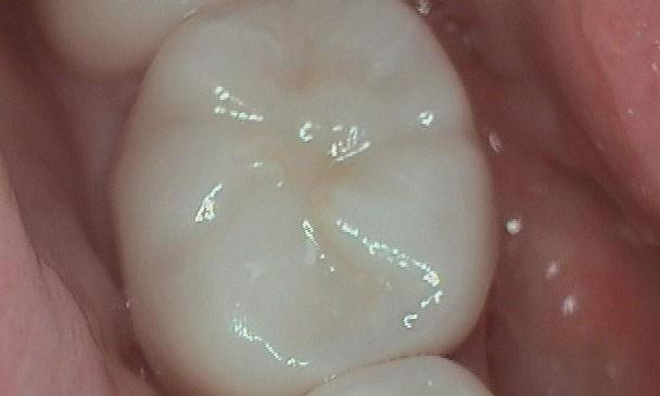 After-Both-teeth-had-old-broken-down