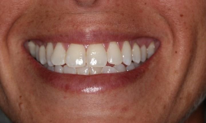 After-Composite-restoration