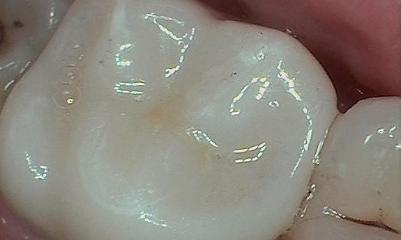 After-Failing-silver-filling-replaced-with-porcelain-crown