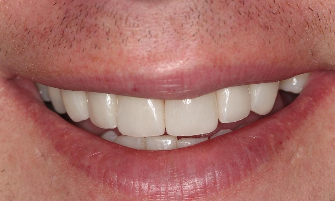 After-Rehabilitation-using-porcelain-crowns