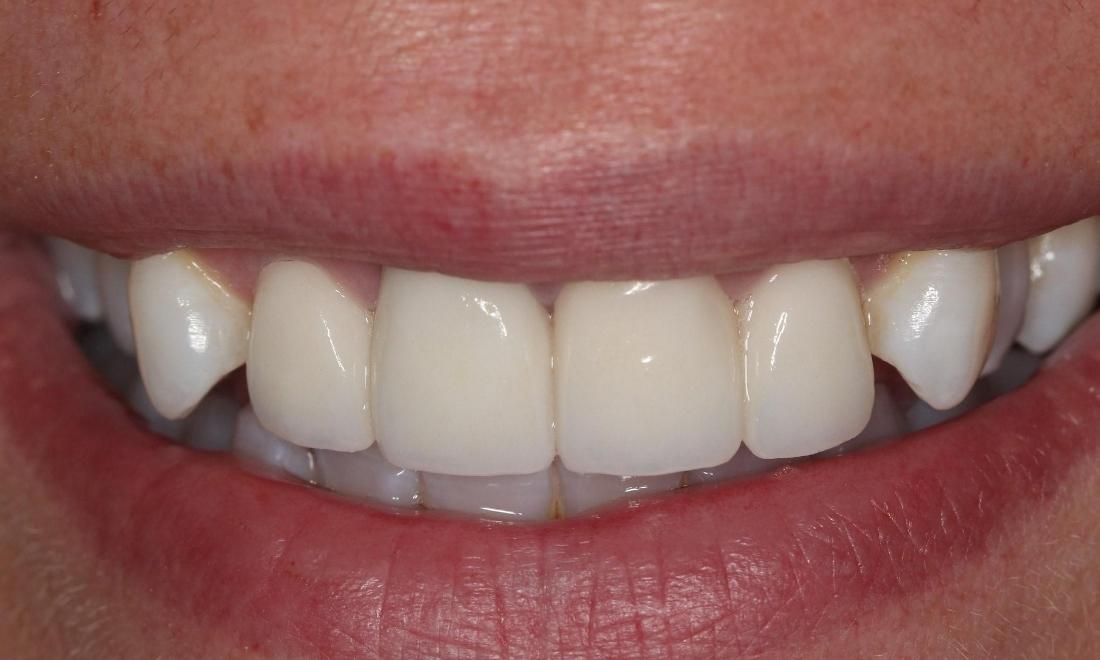 After-Replaced-four-front-crowns