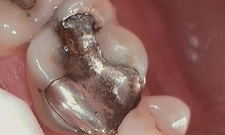 Before-Failing-silver-filling-replaced-with-porcelain-crown