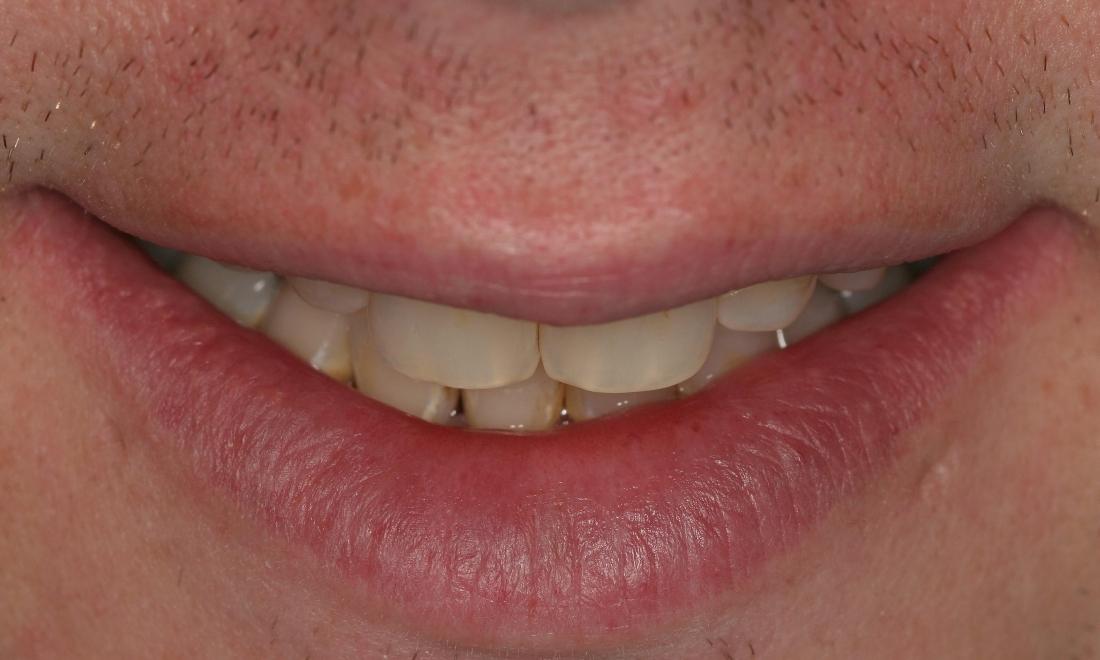 Before-Rehabilitation-using-porcelain-crowns
