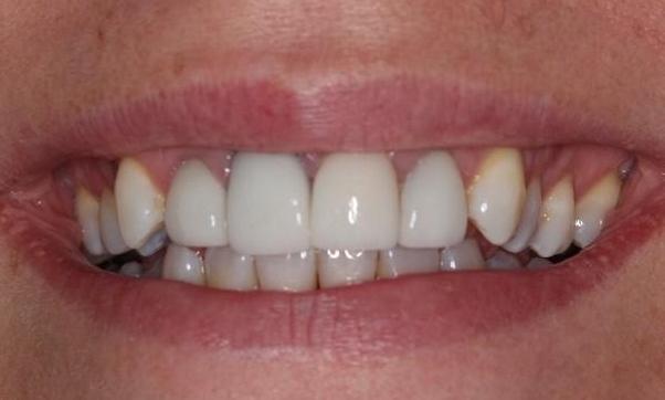 Before-Replaced-four-front-crowns