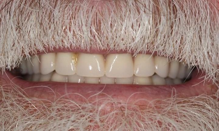 After restored upper dentures