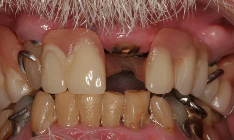 Before the restore demtures of patient