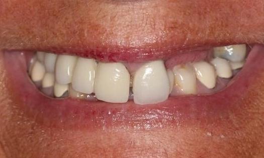 Before Upper Implant denutres